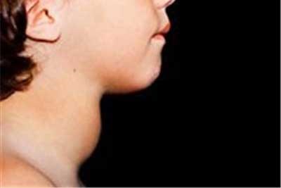 سرطان تیروئید ارمغان تجویزهای بی رویه رادیولوژی
