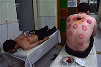 رئیس انجمن علمی طب سنتی ایران: حجامت برای چه کسانی ممنوع است؟